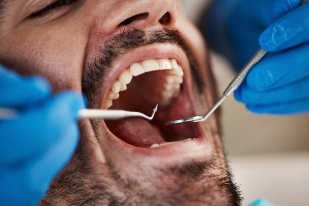Best Broken or Cracked Tooth Emergency Dentist in Soulsbyville, CA